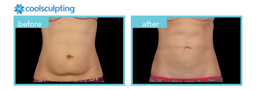 Body Contouring - Mon Ami Spa & Laser Center, Jackson