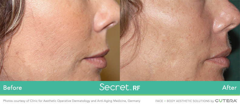 RF Laser Skin Tightening - Adore Skin Studio