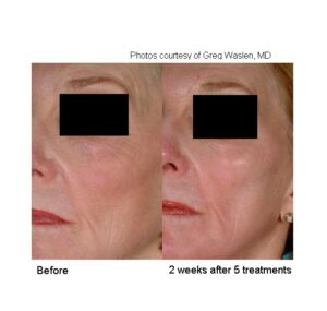 Laser Genesis Before After
