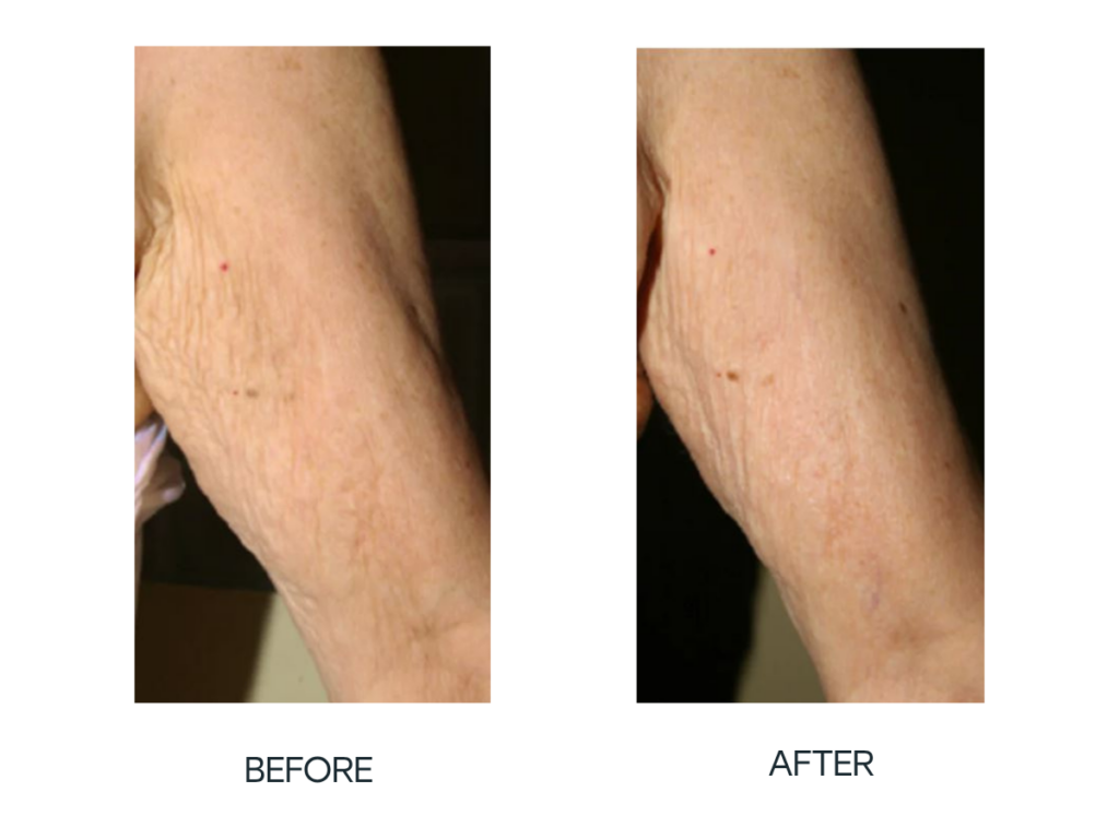 PRX Arms Before After